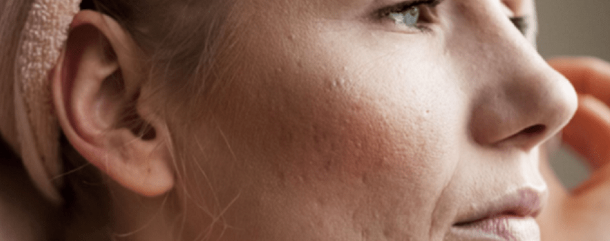 Problematická a mastná pleť