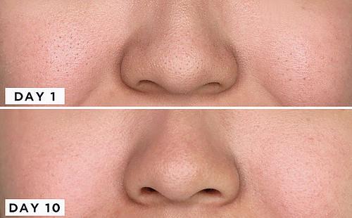 COSRX BHA Blackhead Power Liquid - jemný chemický peeling s BHA na čištění pórů