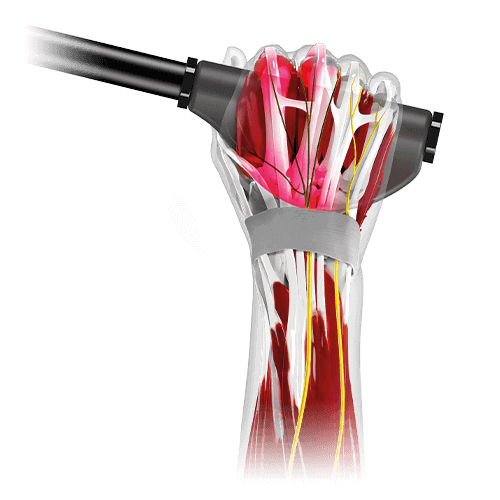 Bolest rukou a prstů, bezpečný úchop