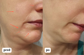 Ultra hydratačný nočný krém pre zmiešanú a mastnú pleť s dvoma druhmi kyseliny hyalurónovej