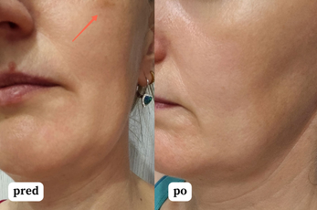 Ultra hydratačný nočný krém pre zmiešanú a mastnú pleť s dvoma druhmi kyseliny hyalurónovej