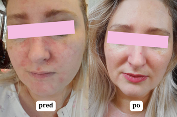 Ochranný denný krém pre suchú aj zrelšiu pleť - s liftingovým účinkom