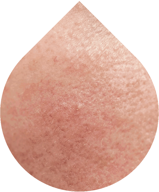 Vyživující krém na suchou a citlivou pleť LOBEY® s redyless