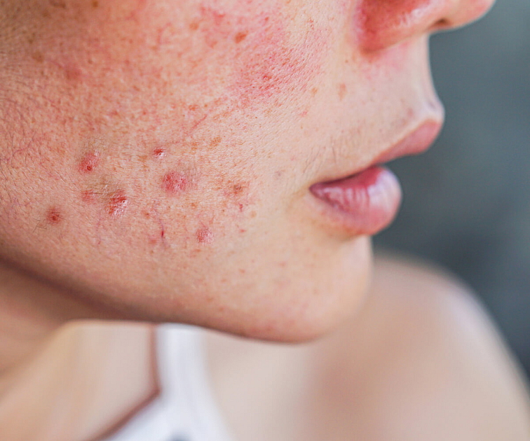 doplnok stravy na akné