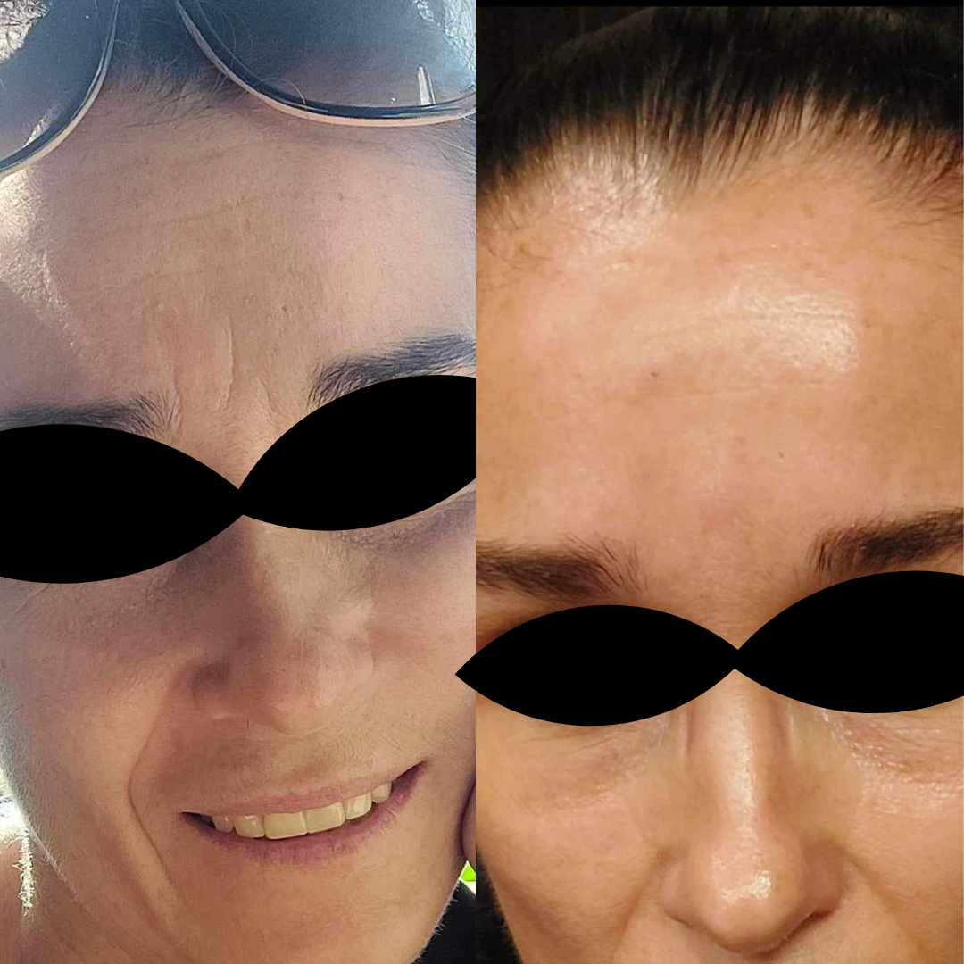 CureTape® Beauty pro tejpování obličeje