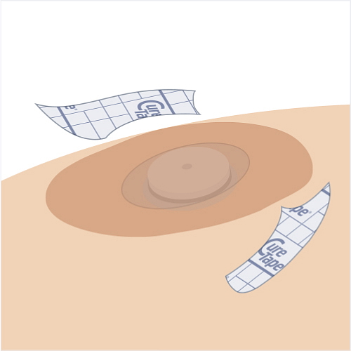 Ochranné náplasti na senzor MIX BAREV CureTape® 8 ks