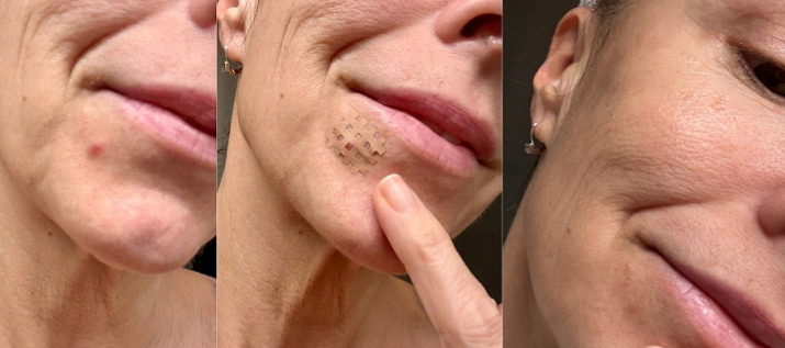 Náplasti CrossLinq® Beauty MIX velikostí S a M